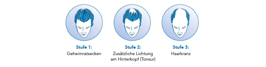 Haarverlustbereiche